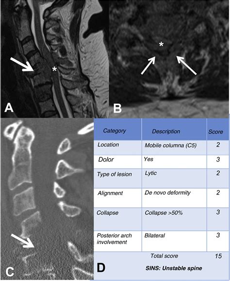 [Translated article] Imaging diagnosis of vertebral metastasis | Revista Española de Cirugía ...