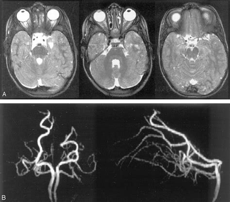 Basilar Artery Mri