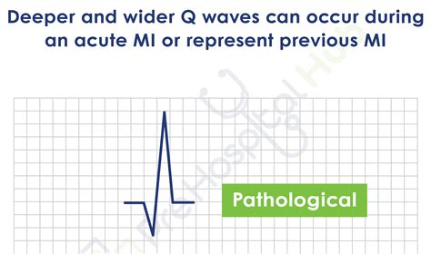 Q Waves - Prehospital Hub