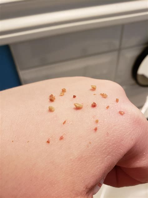 Found a hidden cave of tonsil stones : r/popping