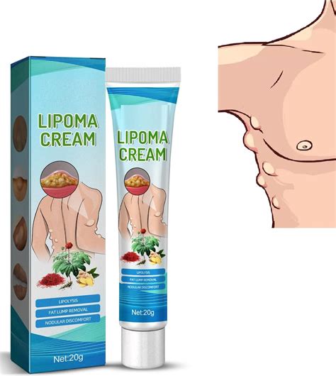 Lipoma Cream,Lipoma Removal Ointment,Fat Lump Cream,Lipoma Elimination Cream,for Lipoma Removal ...