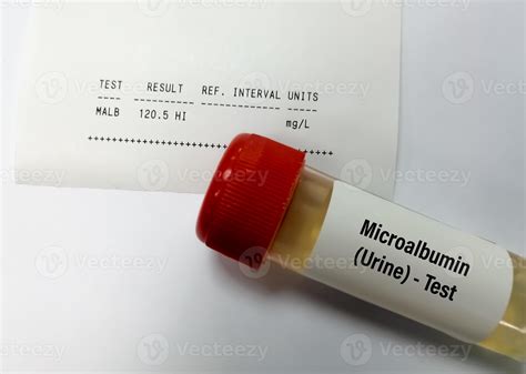 Urine Sample for Urine Microalbumin test. Chronic kidney disease or CKD ...