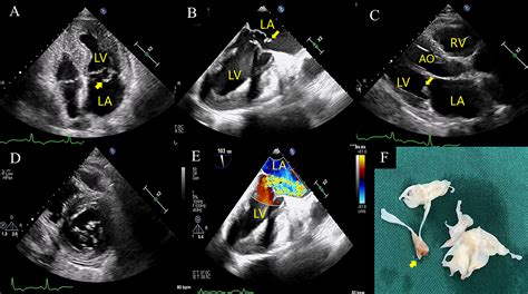 Echocardiographic diagnosis of rupture of mitral valve papillary muscle - International Journal ...