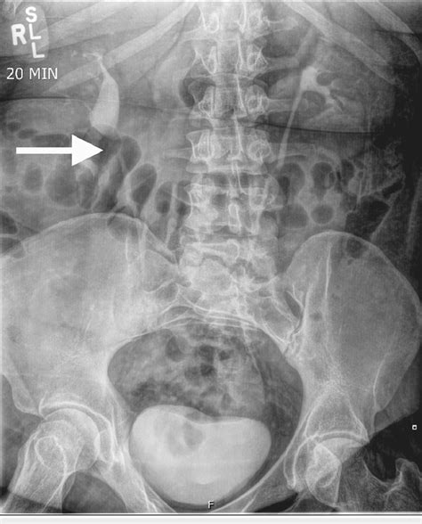 Image result for IV Pyelogram