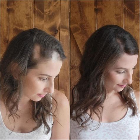 The BEST Cover-up for Alopecia Areata - UniWigs Hair Patches