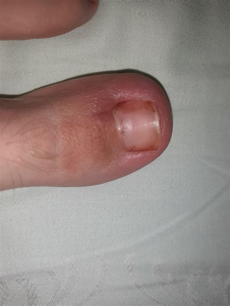 Pus Under Toenail After Injury at Victoria Gregory blog