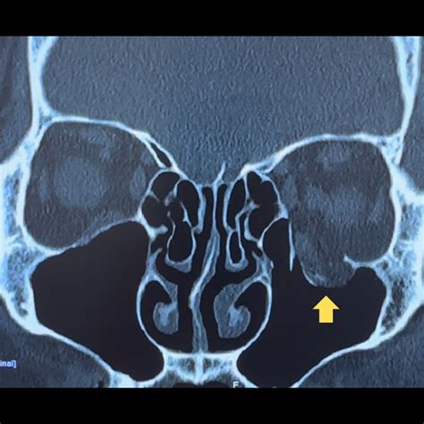 Orbital Fractures: Causes, Risks, And Treatment Explained