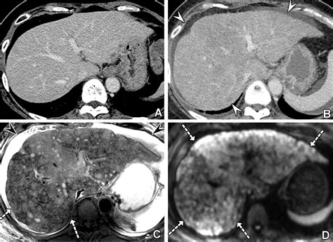 Liver Metastases: Correlation between Imaging Features and Pathomolecular EnvironmentsRadioGraphics