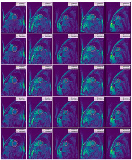 Deep Learning Approach for Automatic Segmentation and Functional ...