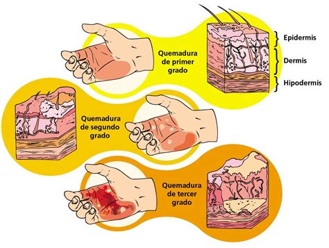 Quemaduras: grados, causas y que hacer [y dudas comunes] – que ...
