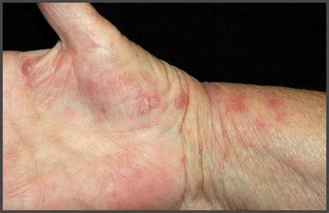 Shingles on hands pictures | Shingles Expert