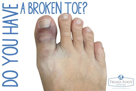 Sprained big toe vs broken big toe – Artofit