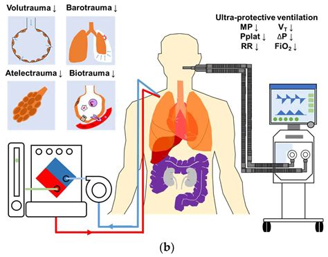 Mechanical Ventilation during Extracorporeal Membrane Oxygenation in ...