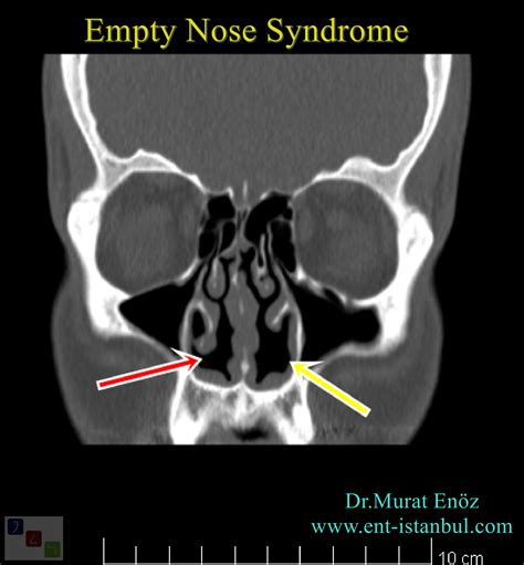 Cool, Small, Dry Turbinate: Empty Nose Syndrome