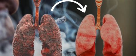 Is Pulmonary Fibrosis Serious? Signs, Stages & Treatment | MrMed