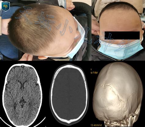 新生儿颅骨凹陷性骨折的治疗体会 - 脑医汇 - 神外资讯 - 神介资讯