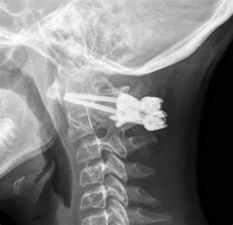 Early Atlantoaxial Subluxation in Enthesitis-related Arthritis | The ...