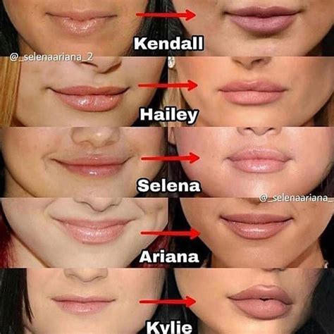 Bildergebnis für best+lip+surgery