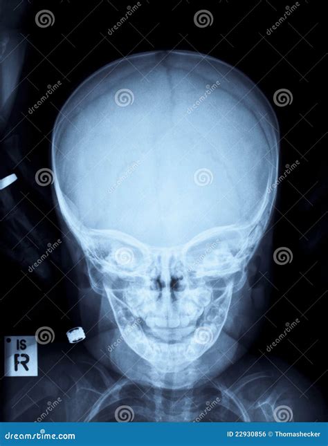 Childs Skull X-ray Image Royalty Free Stock Image - Image: 22930856