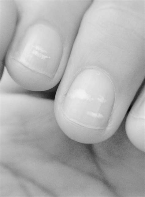 Zinc Deficiency Symptoms Nails ⚠Nail Deficiency Signs: 1. Medium Or