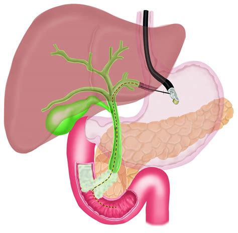 Stent In Liver Duct