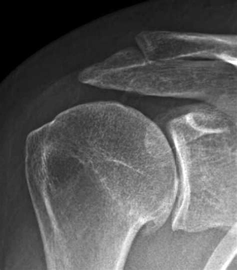 UW Shoulder and Elbow Academy: Shoulder joint replacement - many different types of arthritis