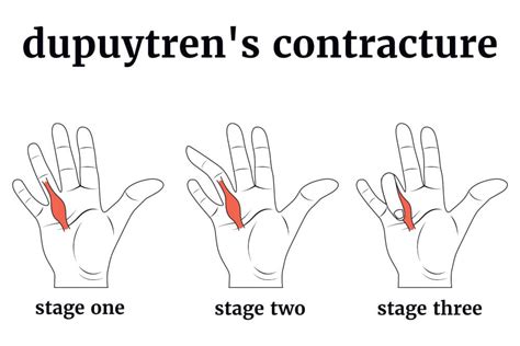 Dupuytren's Contracture Therapy & Treatment - Prescott, AZ