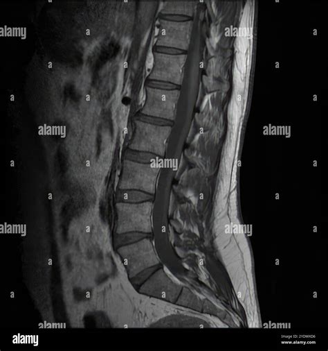 Sagittal mri scan of the lumbar spine showing healthy vertebrae and spinal cord Stock Photo - Alamy