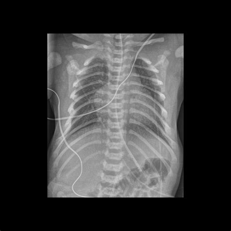 Premature newborn after umbilical arterial catheter placement | Pediatric Radiology Case ...