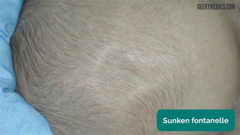 Newborn Baby Assessment (NIPE) - OSCE Guide | Geeky Medics