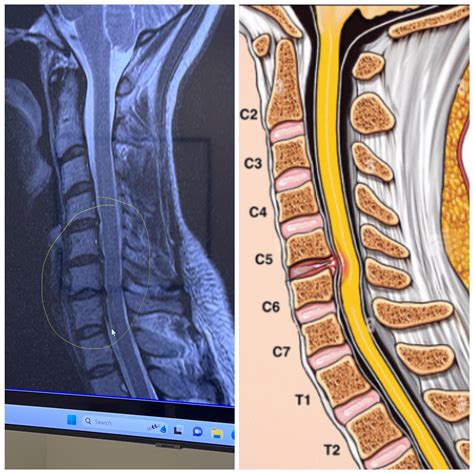Please help! 3 bulging discs in my neck (C5, C6,C7)with excruciating ...