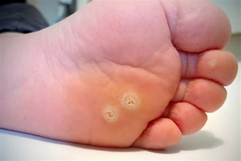 Plantar Warts | Foot Specialist Toronto | Feet First Clinic