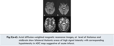 Artery of Percheron Infarction in a Patient with Atrial Fibrillation: A ...