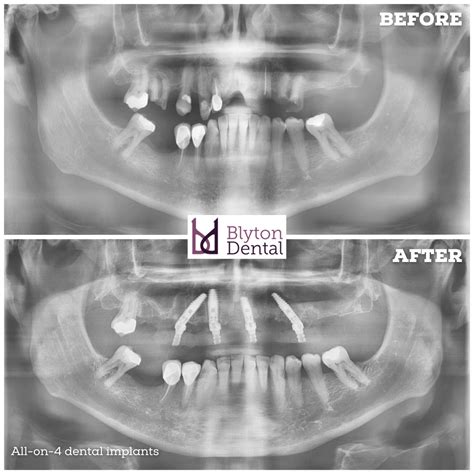 All-on-4 dental implants — Blyton Dental