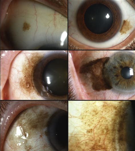 Conjunctival Primary Acquired Melanosis: Is It Time for a New ...