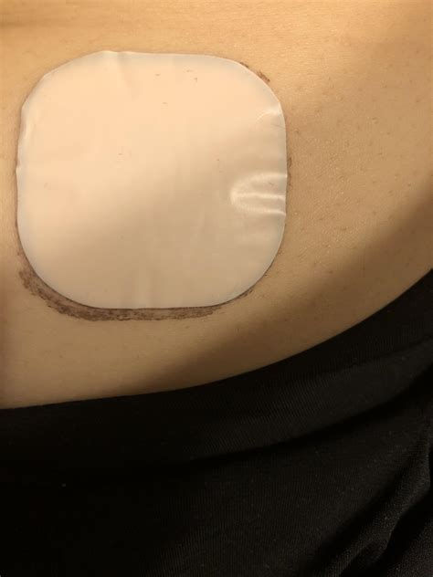 Birth Control Patch Placement