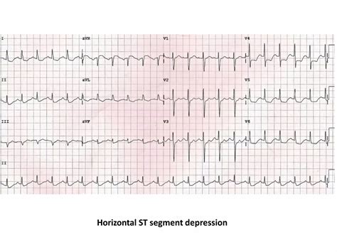 ECG Changes in Myocardial ischemia, myocardial infarction.pptx