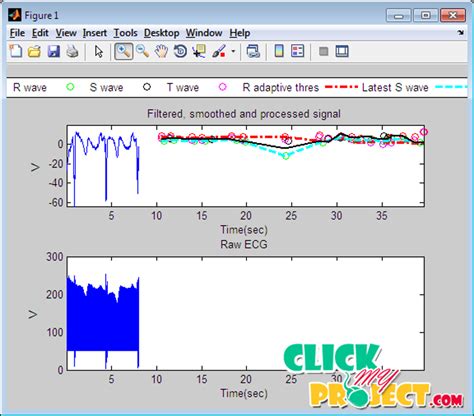 ECG Machine Learning Python Project 的图像结果