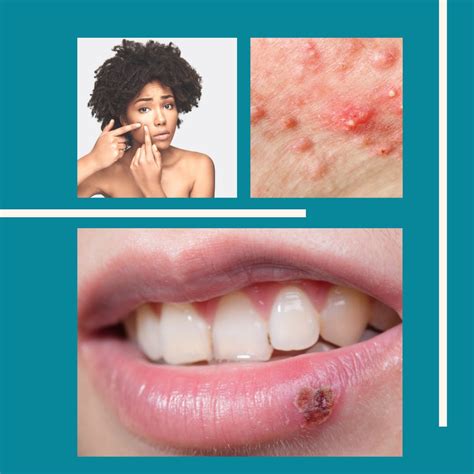 Pimples Vs Cold Sores | Experts Explain