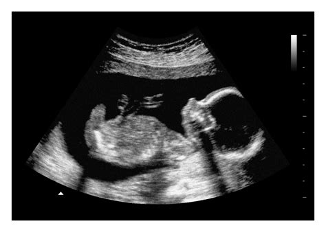 20 Week Fetus Ultrasound Images