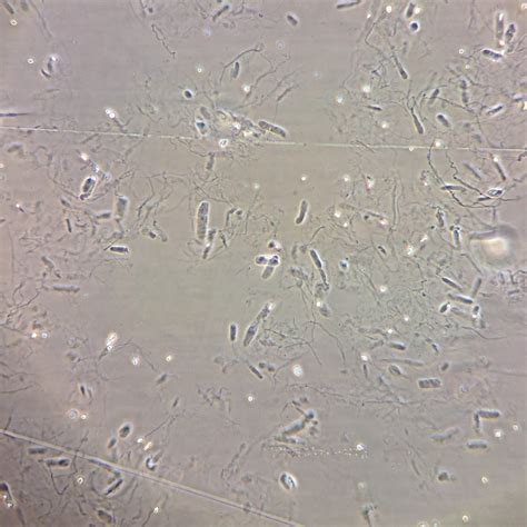 Granular Casts: Identification & Significance - MedLabBuddy