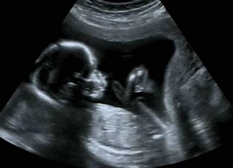 怀孕19周胎儿发育情况及胎动特点，胎动不稳定时有时无正常吗？ - 每日头条