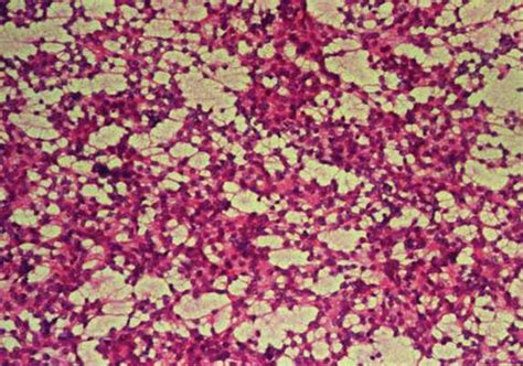 Cytodiagnosis of Scalp Lesions