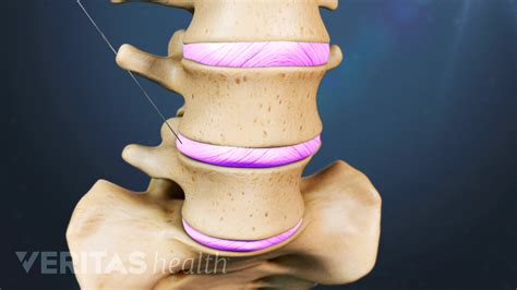 Lumbar Discogram Procedure | Spine-health