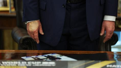 Here's what the White House has said about Trump's hand makeup, bruise