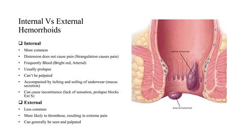 Hemorrhoids.pptx