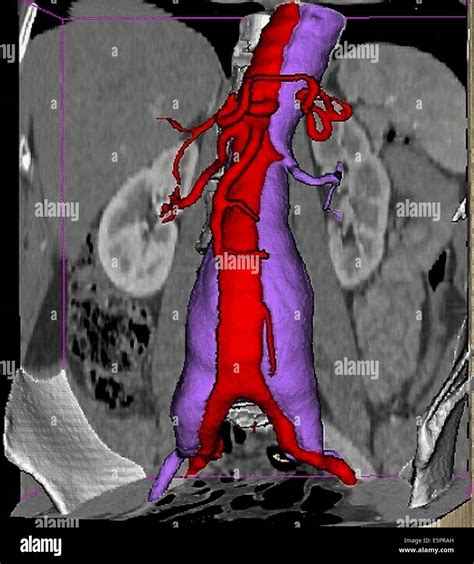 3D computed tomographic (CT) scan reconstruction of a dissecting ...
