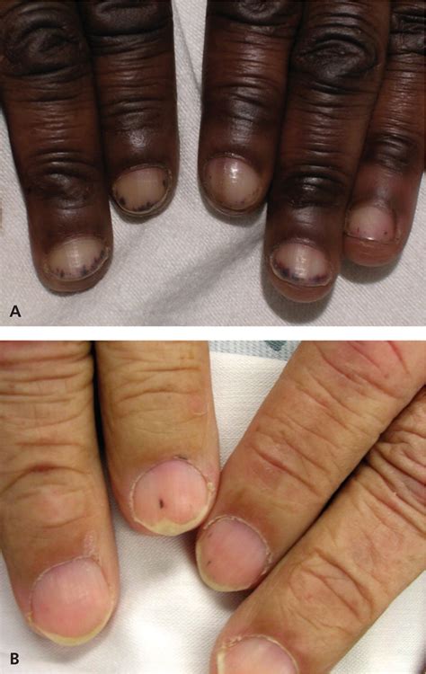Fingernails - Ingrown fingernails - Dark Line - Fingernail Pain