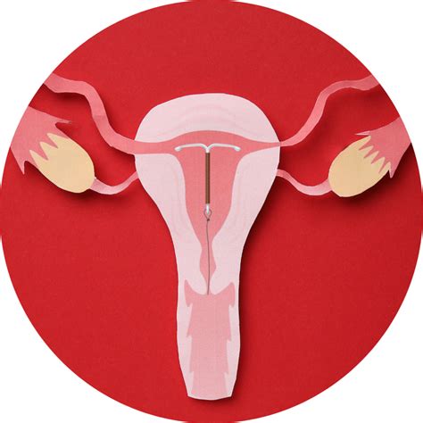 Tudo sobre DIU de Cobre: como funciona, benefícios e indicações