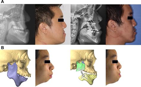 Orthognathic Surgery for Obstructive Sleep Apnea - Oral and Maxillofacial Surgery Clinics